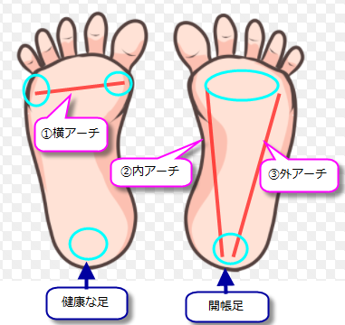 開帳足 かいちょうそく と外反母趾の関係について 自分でできる 外反母趾の治し方